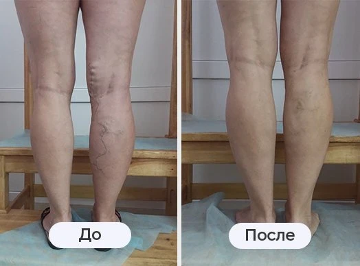 фотография до и после лазерного лечения в клинике Варикоза нет в Воронеж